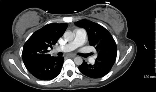 Computed tomography showing bilateral breast densities, showing nearly
                        symmetric involvement of the entirety of each breast with no apparent chest
                        wall or skin involvement.