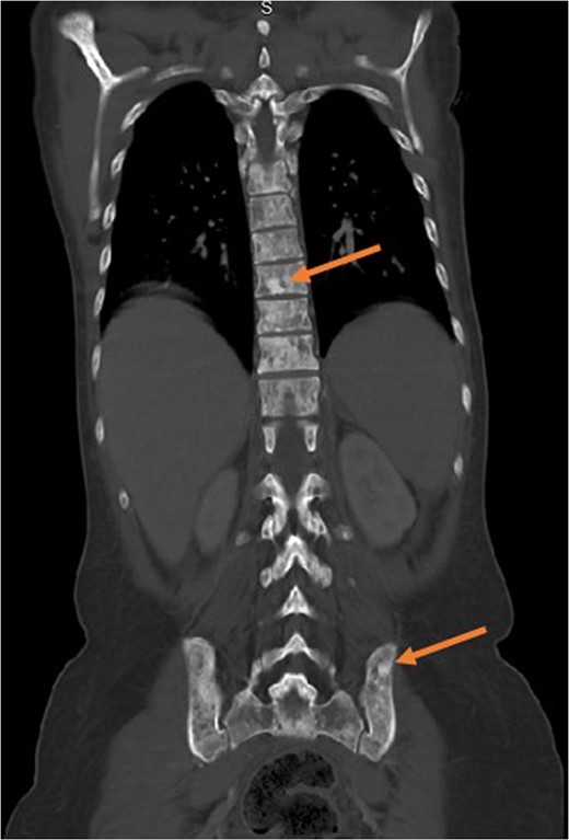 Computed tomography showing diffuse metastases to the spinal column and
                        pelvis. This image exemplifies the propensity of signet-ring cells for bone
                        and bone marrow, leaving other organs essentially untouched.