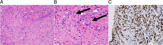 From left to right. (A) 200× magnification of CNB showing a
field of fibrotic tissue with signet-ring cell. (B) 400×
magnification highlighting signet-ring cells. (C) CA 15-3
antigen positivity on stain, suggestive of breast origin.