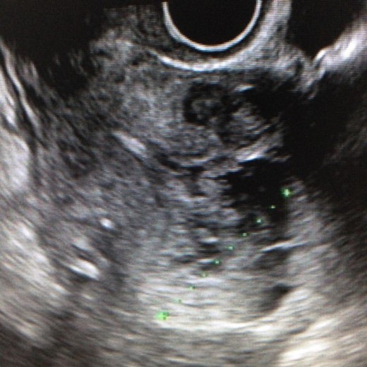Transvaginal ultrasonography showing a endometrial thickening with echogenic
pattern.