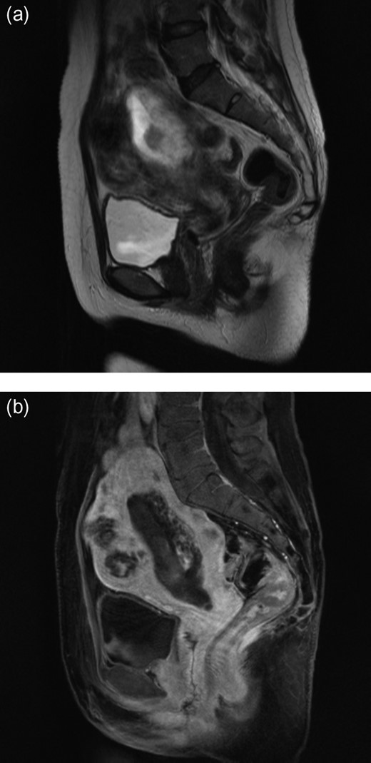 MRI showing invasion into the uterine cervix (a) and myometrium
invasion in the posterior wall of the uterus (b).