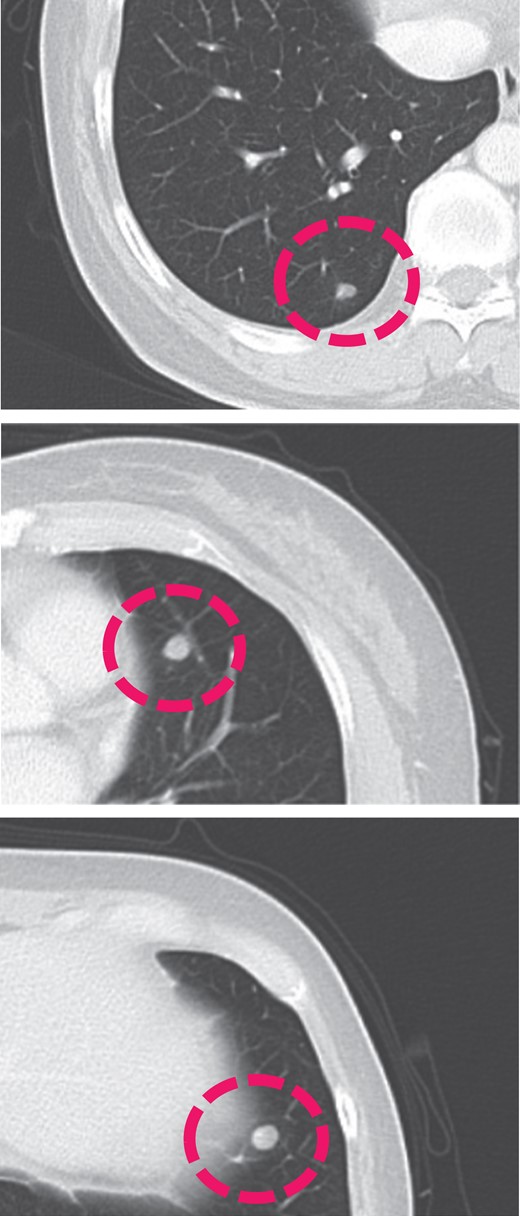 Contrast computed tomography scan showing the metastasis in the lungs.