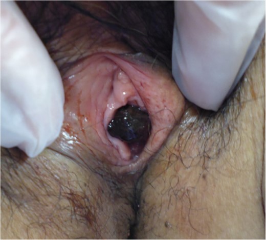 A metastasis to the labium minus.