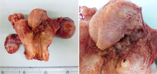 Gross specimen obtained after the TAH and bilateral salpingo-oophorectomy. In
the close-up on the right, molar vesicles can be seen at the uterine
corpus.