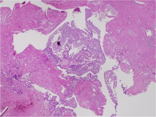 Histopathological staining shows the invasions into the myometrium by both
the villi and trophoblasts.