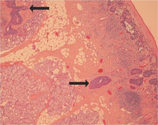 Slide showing ductal colonization by the tumour cells as shown by the
arrows.
