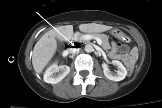 Axial contrast-enhanced CT image of the abdomen demonstrating air within the
                        IVC (arrow).