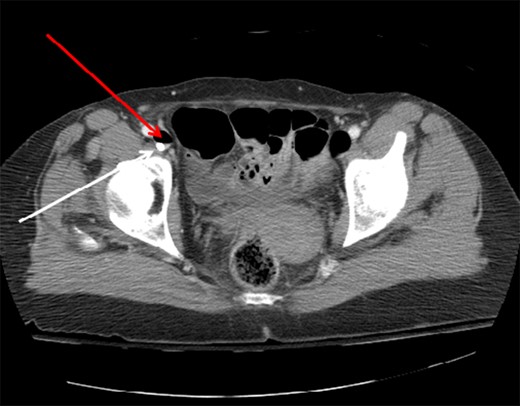 Axial CT image of the pelvis demonstrating the CVC (white arrow) with
                        adjacent air (red arrow) in the right external iliac vein.