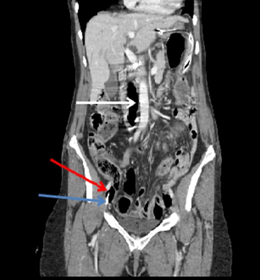 Coronal CT image of the abdomen and pelvis showing a significant amount of
                        air within the IVC (white arrow). Note the CVC (blue arrow) and additional
                        air (red arrow) in the right external iliac vein.