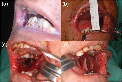 Case 1. (a and b) A 48-year-old man presented
with severe trismus with preoperative and intraoperative IIDs of 5 and
32 mm, respectively (c and d). After release
of submucous fibrosis, the right buccal defect was 8 × 4 cm and the left
buccal defect was 9 × 6 cm.
