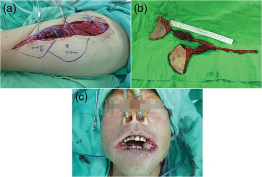 Case 1. (a and b) Bipaddled ALT perforator flap
                            was harvested from the descending branch of the lateral circumflex
                            femoral artery. Bridged pedicle length was 8 cm, and the common mother
                            vessel length was 10 cm. (c) Intraoperative appearance
                            after flap was placed on both sides.