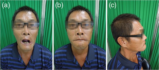 Case 1. (a) The IID was 25 mm at the 4-month follow-up.
                                (b and c) Anterior and lateral views
                            showed inward displacement of the lip.
