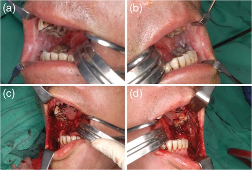Case 2. (a and b) A 47-year-old man had
bilateral buccal squamous cell carcinoma with an interincisal distance
of 15 mm. (c and d) Following tumor ablation
and the release of trismus, bilateral buccal defects were 10 × 7 cm and
10 × 7 cm, respectively.