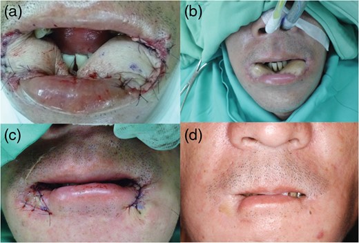 Case 2. (a) Intraoperative appearance after reconstruction
with bipaddled ALT perforator flap. (b) This image showed
bulky flap after 1.5 months’ follow-up. (c) The patient
received secondary de-bulking and commissuroplasty 3 months after
reconstruction. (d) Appearance of the patient at the
7-month follow-up.