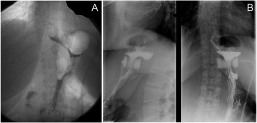 Contrast meal before and after pregnancy. (A) The band in good
place 1 month before the beginning of pregnancy with good emptying of the
gastric pouch. (B) The anterior band slippage with incomplete
superior gastric pouch occlusion, 6 weeks after delivery.