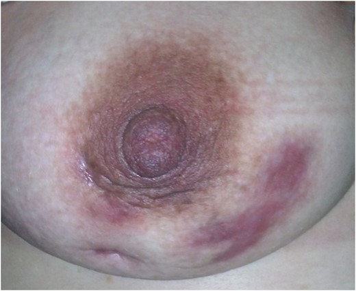 Right Breast IGM.