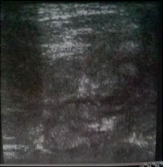 IGM image is similar to breast cancer.