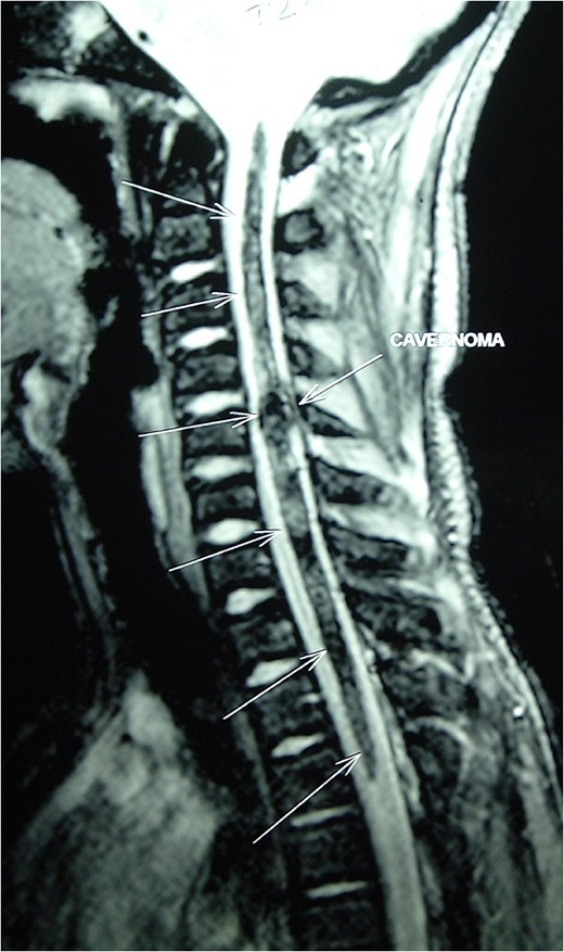 MRI Spine (GRE T2WI) sagittal view shows a localized lesion within the spinal
cord at C5 with a mixed intensity focus centrally and a surrounding
low-signal ring typical of cavernous angioma with surrounding hemosiderin
deposition.