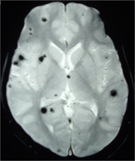 MRI Brain (GRE T2WI) showing multiple hypointense lesions diagnosed as
                        cerebral cavernomas.