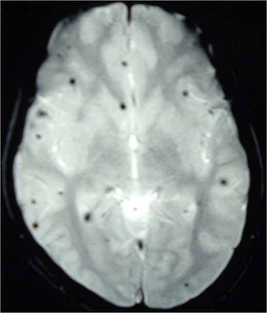 MRI Brain (GRE T2WI) showing multiple hypointense lesions diagnosed as
                        cerebral cavernomas.