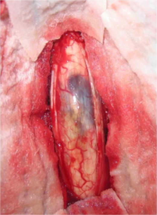 Intraoperative image at C5 showing subpial bluish discoloration at the spinal
                        cord surface with underlying cavernous angioma.