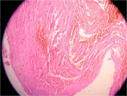 Photomicrograph one showing a vascular lesion composed of thin-walled,
venous-type, congested blood vessels of various sizes closely packed
together.