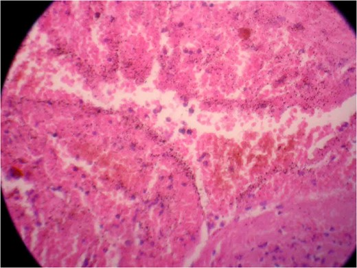 Photomicrograph two showing a vascular lesion composed of thin-walled,
                        venous-type, congested blood vessels of various sizes closely packed
                        together.