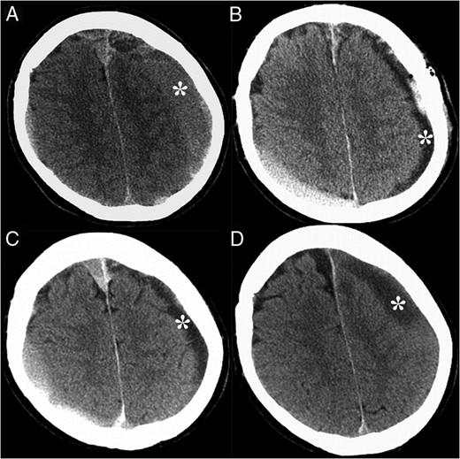 CT of the head without contrast demonstrated CSDH, denoted by the asterisks,
at the initial presentation (A), after the procedure
(B), 7 days later (C) and 4 weeks later, when
the CSDH has enlarged (D). Acute subdural hematoma was also
noted in the right posterior frontoparietal region.