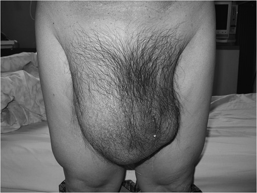 Giant inguinal hernia at admission extending below the knee while
standing.