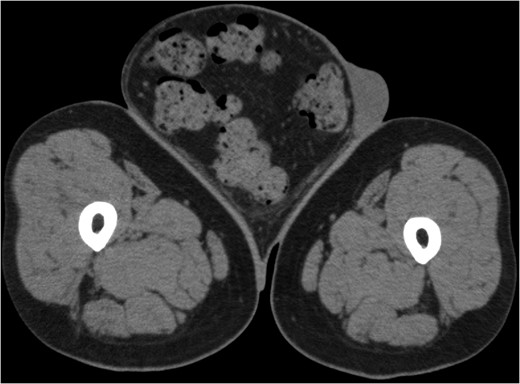 Computerized tomography image of the hernia on admission, indicating the
                        sigmoid colon, including a large amount of feces inside the sigmoid colon,
                        and the greater omentum as part of the contents of the hernia.