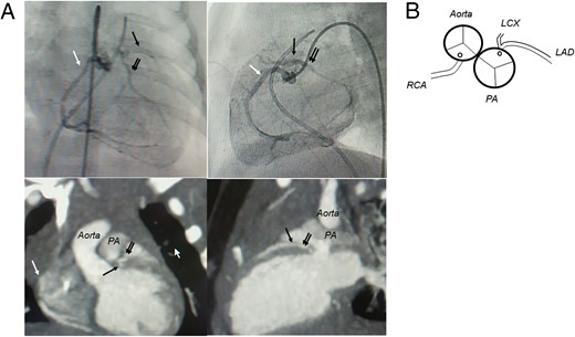 (A) Preoperative cardiac catheter angiography, contrast CT and
(B) the schema of the coronary pattern. The aorta is
located right and posterior to the PA, and the left coronary artery with a
very short main coronary trunk originates from the rightward posterior sinus
of the PA (LAD: left anterior descending artery, black arrow; LCX: left
circumflex artery, double arrows; RCA: right coronary artery, white
arrow).