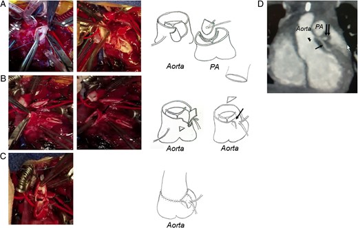 Intraoperative pictures and the schema of the operative procedure.
(A) After the transection of both the aorta and PA, a large
coronary button is excised and mobilized from the PA trunk. The trap-door
incision is subsequently made in the aorta above the sinotubular junction.
(B) The coronary cuff is sewn, and the superior excess cuff
is folded inside and covered with the bulged coronary channel (black arrow)
after partial resection of the superior edge of the J-shaped aortic flap.
(C) The proximal aortic stump is anastomosed to the
ascending aorta, and the anterior wall of the transverse section of the
ascending aorta is anastomosed to the inner edge of the folded-down cuff.
(D) Postoperative computed tomography coronary angiography
shows the new coronary channel of the left coronary artery (arrow head)
arising from the ascending aorta above the sinotubular junction (left
anterior descending artery, black arrow; left circumflex artery, double
arrows).