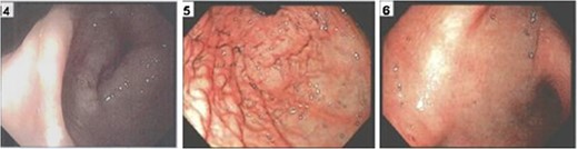 Rectal stricture (left), external compression of antrum (middle), duodenal
bulb wall thickening (right).