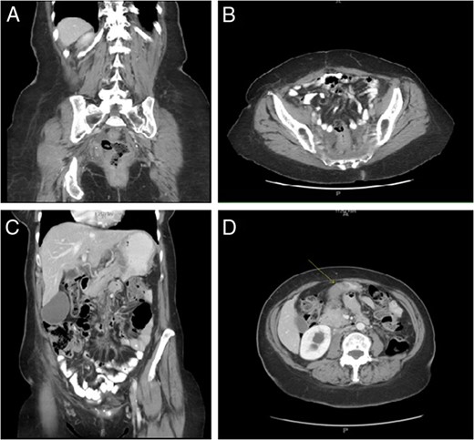 Circumferential rectosigmoid mural thickening (A, B); Duodenal
bulb wall thickening (C, D).