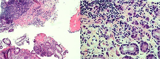 Rectal mass biopsy with atypical submucosal infiltrate with stains indicative
of poorly differentiated carcinoma with breast primary (left); Gastric
mucosa biopsy with poorly differentiated malignant large cell neoplasm,
stains consistent with metastatic breast adenocarcinoma (right).
