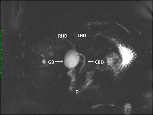 This MRCP demonstrates a large gallbladder remnant (GB). The anatomy of the
duodenum (D), CBD, left (LHD) and right hepatic ducts (RHD) are normal.
There are no CBD stones present.