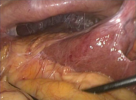 Multiple adhesions were present in the right upper quadrant preventing
visualization of the gallbladder remnant.