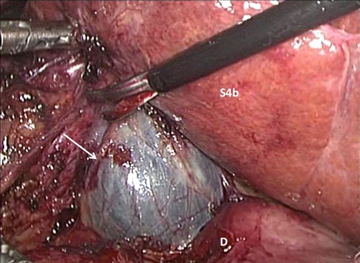 Careful dissection with ‘hot scissors’ has presented the ‘fundus’ of the
gallbladder remnant (arrow). The duodenum (D) and segment IVb of the liver
(s4b) are visible after dissection.