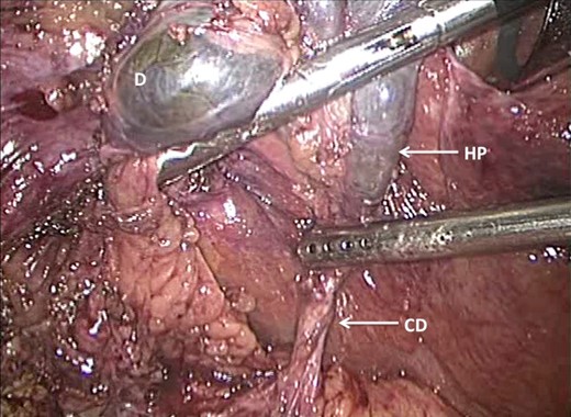 The ‘dome down’ (anterograde) dissection technique has been used to dissect
from the dome (D) onto Hartmann's pouch (HP) as it tapers into the CD.