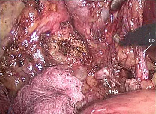 Dissection has presented Rouviere's sulcus (open-type) with the right hepatic
artery (RHA) visible superficially. The close relationship to the CD in
Calot's triangle is demonstrated.