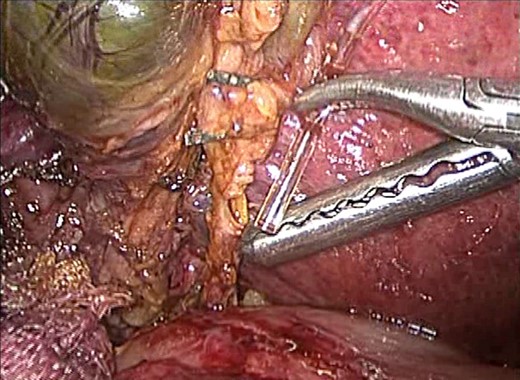 A 5 Fr infant feeding tube is fed into the opened CD in order to perform an
intraoperative cholangiogram.