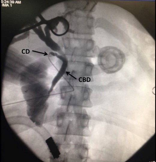 Choangiogram film demonstrating the catheter as it enters into the CD. A
normal CBD is noted. There are no stones in the CBD and contrast is seen
entering the duodenum.