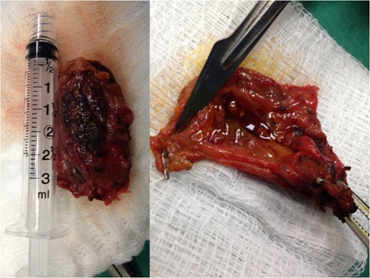 The 3.5 × 2 cm gallbladder remnant has been extracted from the abdomen.
Multiple stones are seen within the remnant.
