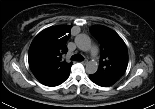 Initial CT revealed a tumor in the right anterior mediastinum with a diameter
of 3.5 cm, round shape, which was clearly demarcated from the neighboring
tissue.