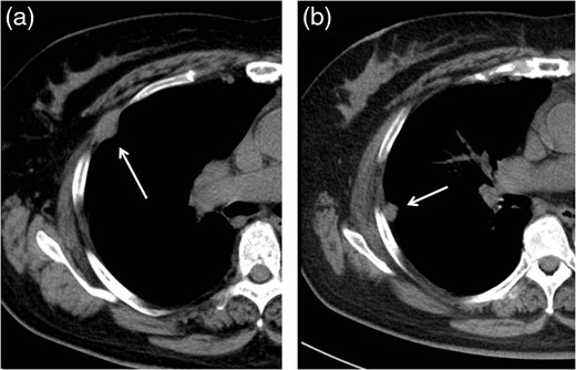 Follow-up CT at 36 months after the operation revealed two pleural tumors
                        locating at the second (a) and third (b) ports
                        used in the VATS operation.
