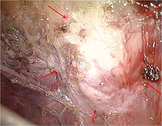 In the operative findings, the tumors were found to have arisen from the
intercostal space, and their surfaces were covered with parietal pleura with
partial irregularity.