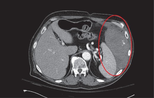 CT axial with intravenous contrast demonstrating a large left abdominal wall hematoma with active contrast extravasation from an intercostal artery.