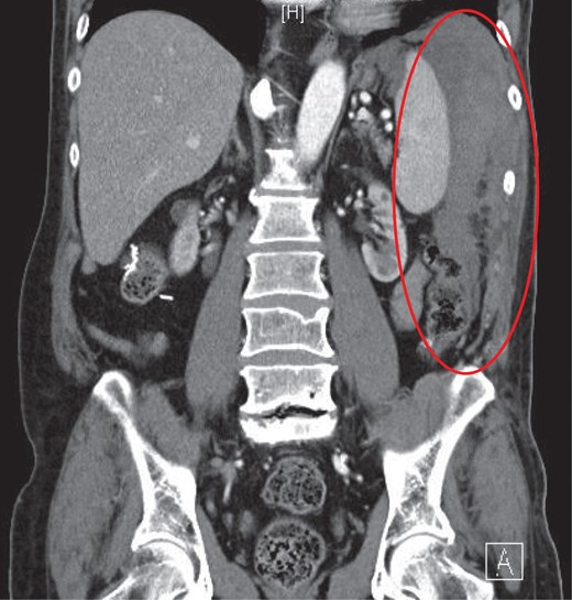 CT coronal with intravenous contrast demonstrating intraperitoneal blood products within the perisplenic region and left paracolic gutter.