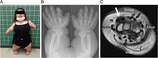 (A) The patient has disproportionate short limbs and stature (height 97 cm, weight 39 kg). (B) Plain postero-anterior radiograph of the bilateral forearms and hands. The forearm bones and phalanges are shortened, the metaphyses are widened and the epiphyses are irregularly shaped. (C) MRI of the cross-section at the level of the distal carpal row level (T1WI) shows hypertrophy of the ECRL and ECRB tendons (arrow). The synoviums around these tendons are also thickened.
