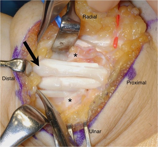 The synoviums around the ECRL and ECRB tendons appear enlarged during the surgery (arrow). Asterisks indicate the stumps of the divided extensor retinaculum.
